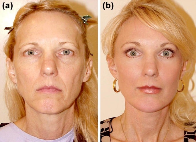 Fat Grafting / Fat Transfer