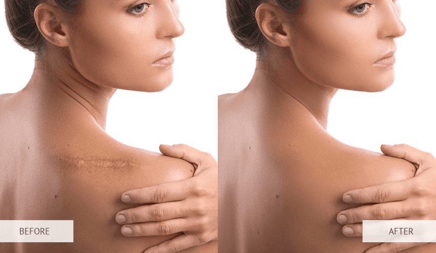 Scar Revision Surgery