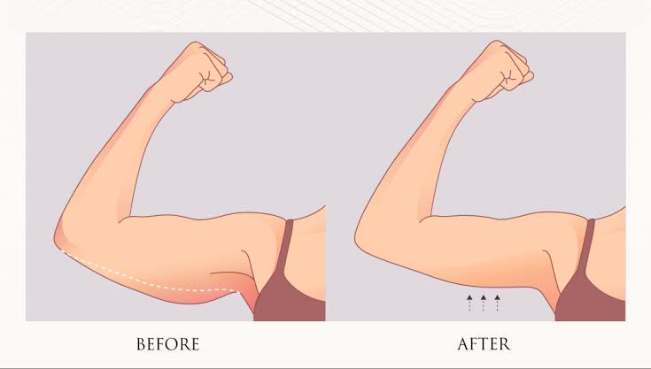 Arm Lift