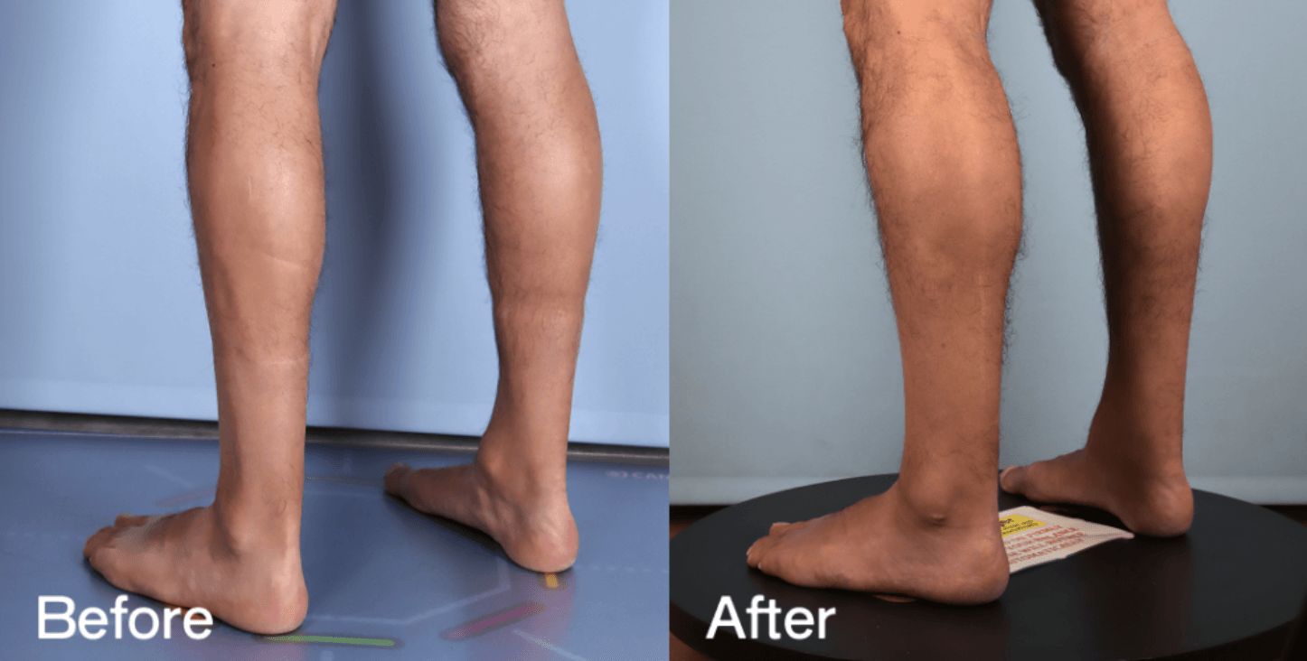 Calf Augmentation / Calf Implants