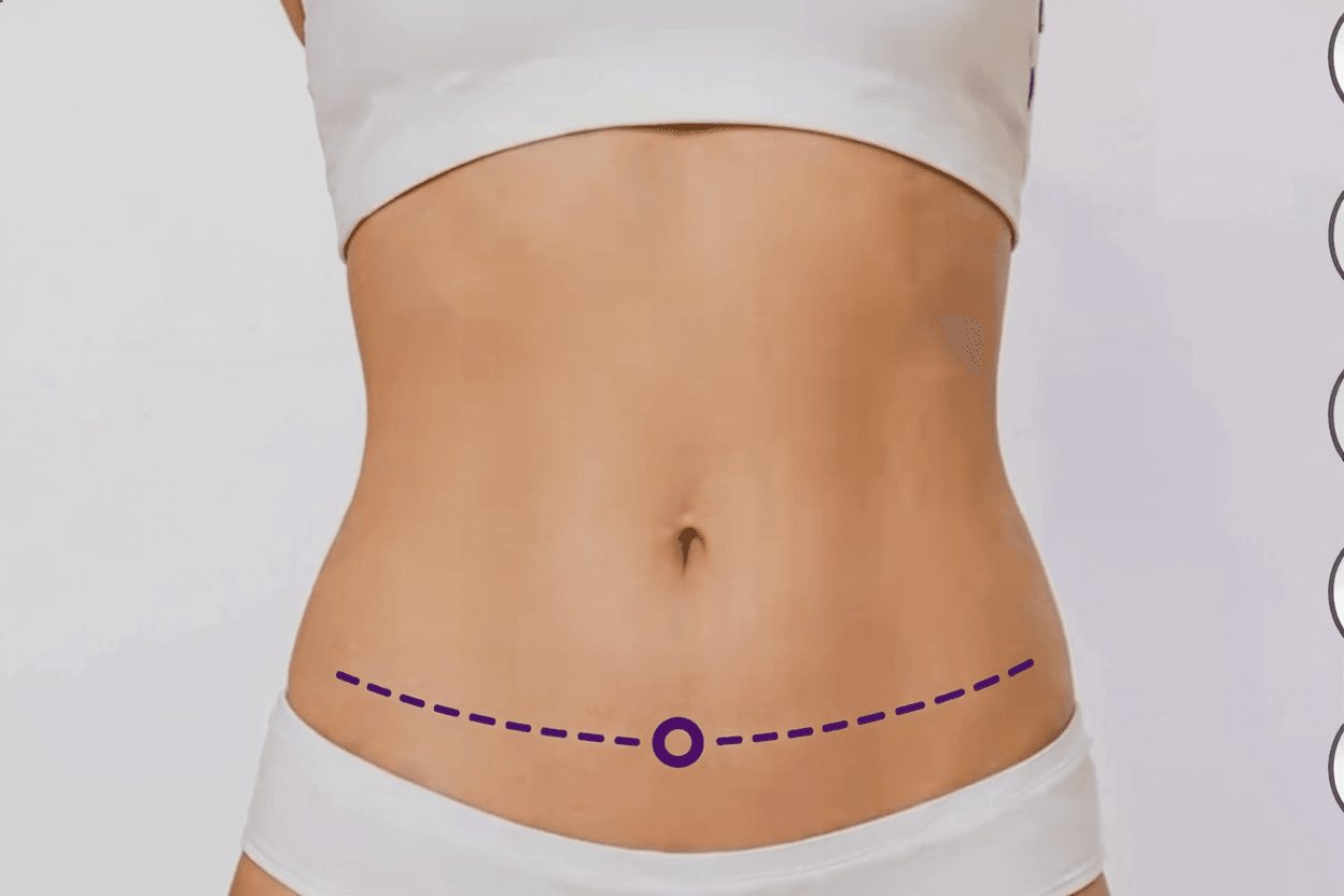 Tummy Tuck / Abdominoplasty